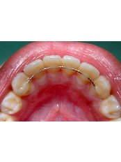 Zahnstabilisator - Victoria Clinic