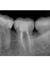 Endodontic Therapy (Root Canal Treatment) - Artdentina