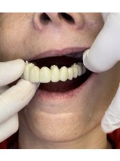 1-Day All-on-4 Dental Implants | Nobel Biocare TiUltra - B2 Dental Clinic
