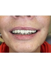 1-Day All-on-4 Dental Implants | Nobel Biocare TiUltra - B2 Dental Clinic