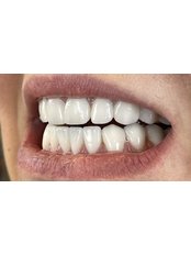 Hollywood Smile Veneers - B2 Dental Clinic