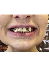 1-Day All-on-6 Dental Implants | Nobel Biocare TiUltra - B2 Dental Clinic