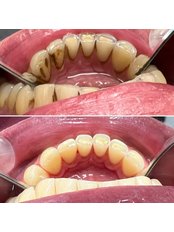 Teeth Cleaning - Bestwaydent Karolina Trusiewicz