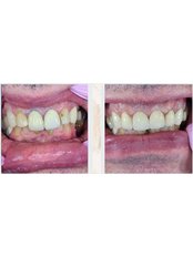 Dental Crowns - Bestwaydent Karolina Trusiewicz