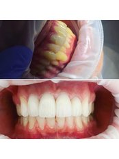 Teeth Whitening - Bestwaydent Karolina Trusiewicz