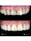 Jesionowa Dental Clinic - Case study 5 - Dental Veneers 