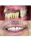 Jesionowa Dental Clinic - Case study 2 Double All on 4 