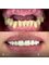 Jesionowa Dental Clinic - Case Study 8 - All on 4 