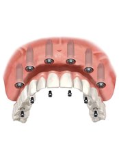 All-on-6 Dental Implants - Jesionowa Dental Clinic