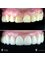 Jesionowa Dental Clinic - Case Study 9 - Crowns + Veneers 