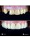 Jesionowa Dental Clinic - Case Study 6 - Zirconia Crowns & Bridge 