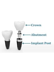 Single Implant Crown - Jesionowa Dental Clinic