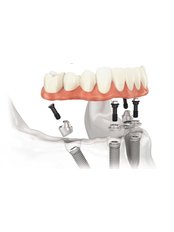 All-on-4 Dental Implants - Jesionowa Dental Clinic
