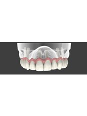 All-on-6 - Jesionowa Dental Clinic