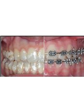 Orthodontics - Colombo & Silva - Dental Clinic