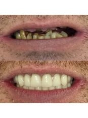 All-on-4 Dental Implants - Colombo & Silva - Dental Clinic