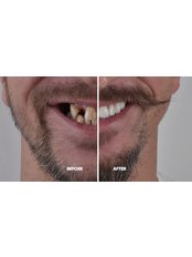Smile Makeover - CDL- Clinica Dentaria de Lisboa