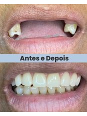 Dentures - Clínica Dr. António Bexiga