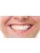 Anne Swart Clinic - Tooth whitening  