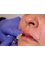 Anne Swart Clinic - Lip enhancement  
