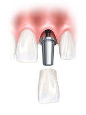 Single Implant - Porto Vita Centro Dental Clinic