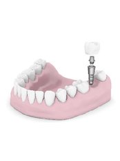 Dental Implant - Porto Vita Centro Dental Clinic