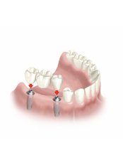Teeth in a day - Porto Vita Centro Dental Clinic