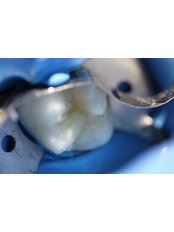 Fillings - Clinica Stomatologica Dentastic