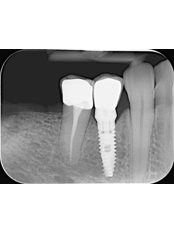 Dental Implants - Clinica Stomatologica Dentastic