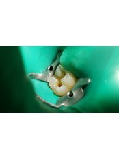 Fillings - Clinica Stomatologica Dentastic