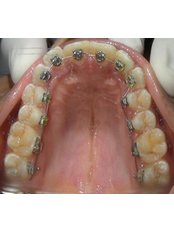 Braces - Best Dental Implant Dent Tehnic