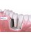 Best Dental Implant Dent Tehnic - implant dentar bestdental 