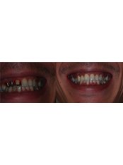 Dental Crowns - Dental Aria