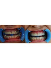 Dental Crowns - Dental Aria