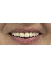 Dental Crowns - Dental Crown Health