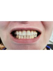Ceramic Crown - Dentist Fara Durere