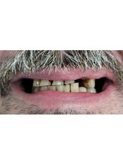 Zirconia Crown - Dentist Fara Durere