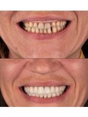 Hollywood Smile - Denttaglio Clinic
