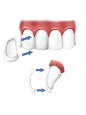 Veneers - Impladent Dental Clinic