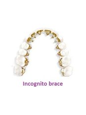 Incognito™ Braces - Radionic Company Dental Clinic