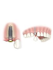 Dental Implants - CENTRUL STOMATOLOGIC ZORILOR- DR.TUDOR POMANA