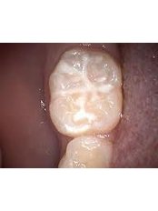 Dental Sealant - CENTRUL STOMATOLOGIC ZORILOR- DR.TUDOR POMANA