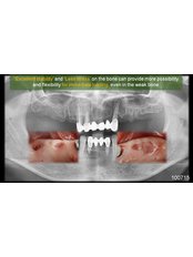 Bone Graft  - ImplantFix Clinic: Dr. Ilie-Dan Sabin