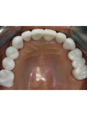 Dental Crowns - ImplantFix Clinic: Dr. Ilie-Dan Sabin