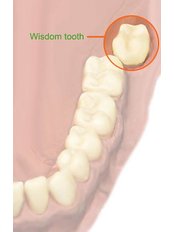 Odontectomy - wisdom tooth extraction	 - Mondent Stoma Dr Mona Pantir