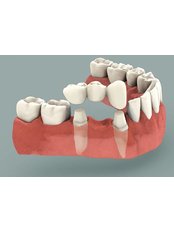 Dental Bridges - Mondent Stoma Dr Mona Pantir