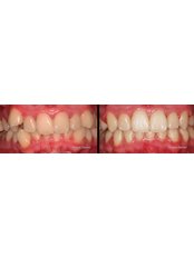 Before and After Orthodonic Treatment - Smart Dental