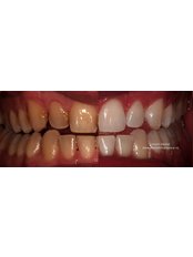 Single Visit ZOOM Whitening Procedure - 45 minutes - Smart Dental