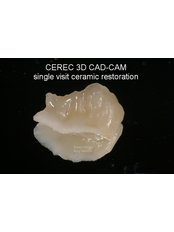 CAD CAM Ceramic Restoration - Smart Dental