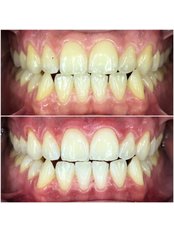 Zoom! Teeth Whitening - Smile Central